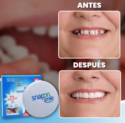 Carillas Dentales Premium - HappySmile 🦷